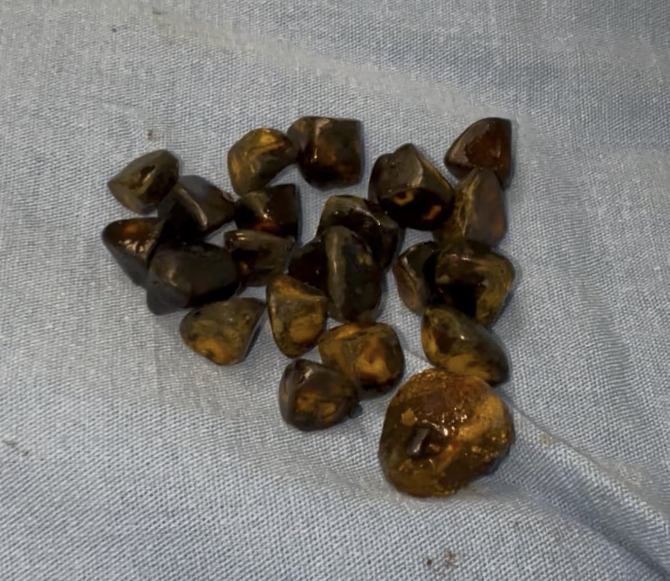 No todos con piedras en la vesícula necesitan operarse. Te explico de forma clara cuándo sí y cuándo no.