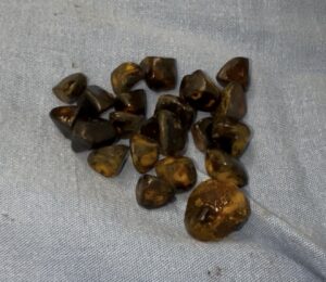 ¿Necesita realmente cirugía de vesícula en Cd. Obregón? Guía clara para pacientes