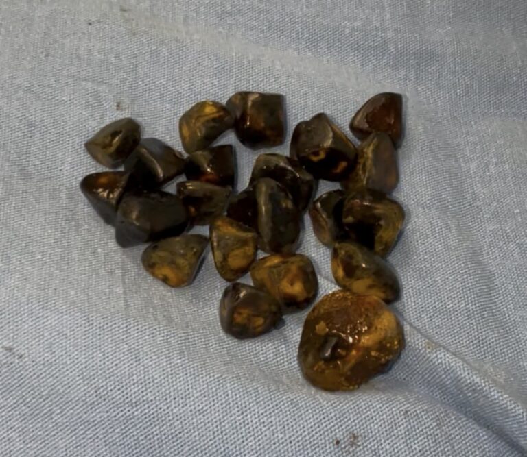 Piedras de vesícula