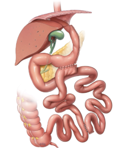 Bipartición intestinal en Ciudad Obregón | Cirugía metabólica