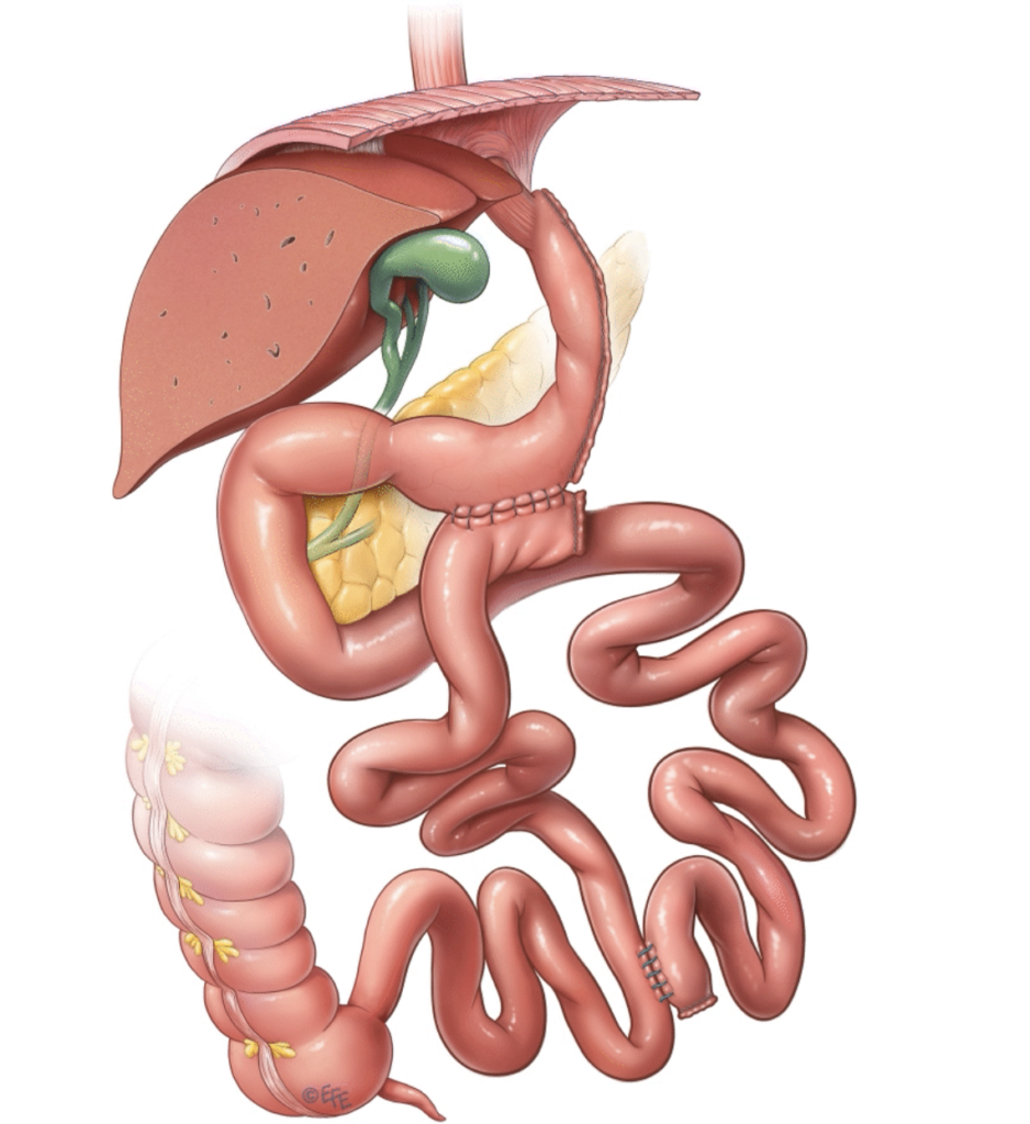 BIPARTICION INTESTINAL EN CIUDAD OBREGON SONORA